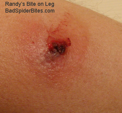 Spider bite on Randy's leg