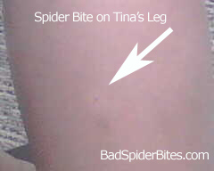 Tina's spider bite