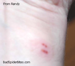 Spider Bite on Wrist