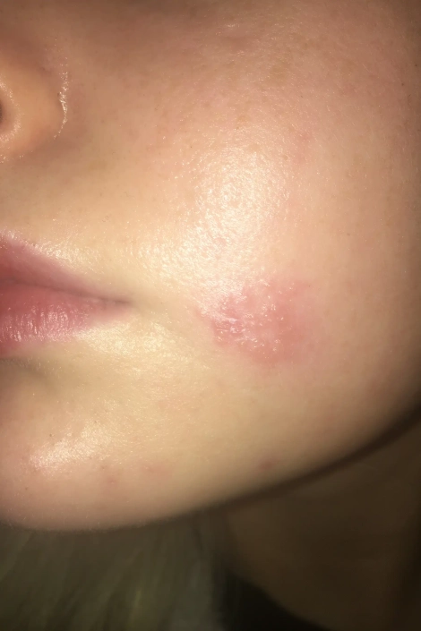 Spider bites on young boys face