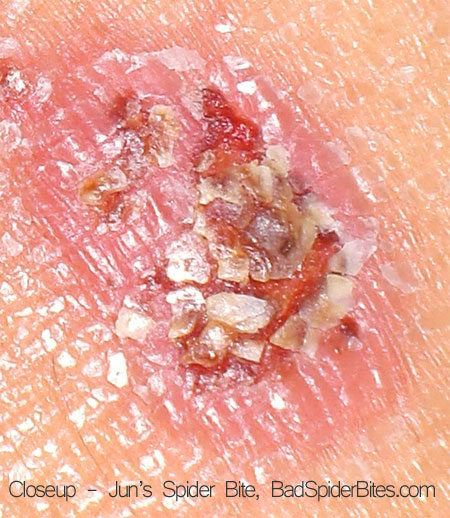 Close up of spider bite on Jun