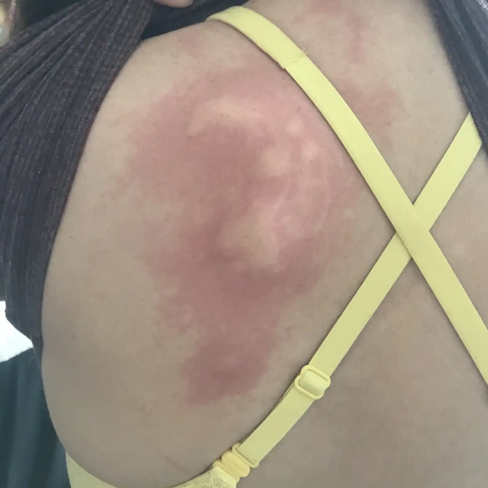 Spider bites caused this swelling on this womans back