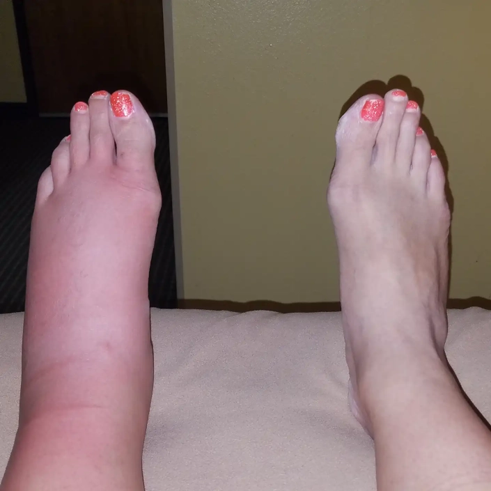 Womans foot bitten by spider is red and swollen