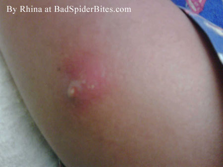 Spider bite on Rhina