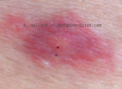 Spider Bite Picture