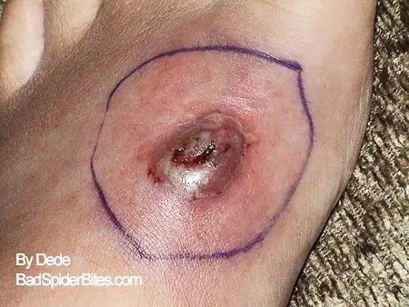 Staph infection on Dedes foot image 2 of 5