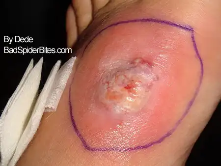 Staph infection on Dede's foot image 1 of 5.