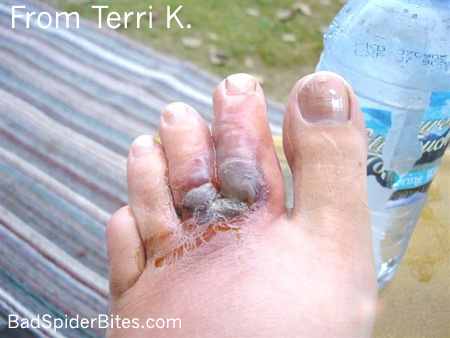 Terri's bite on the fifth day, blistered and dark