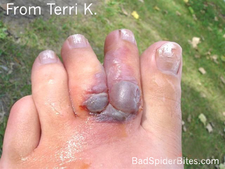 Terri's bite a few hours after it happened