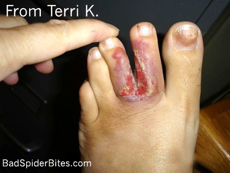 Terri's wound healing ten days after surgery