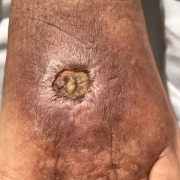 This is what MRSA looks like after healing